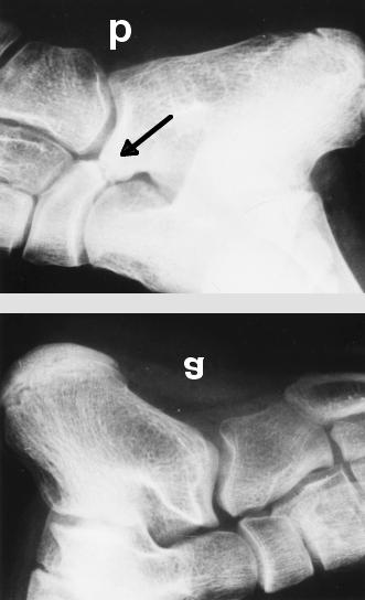 right foot (b) with calcaneonavicular coalition (arrow) stitucijski labave zglobove što sve treba utvrditi pregledom (7). U adolescentnoj dobi bolno spušteno stopalo može biti znak tarzalne koalicije.