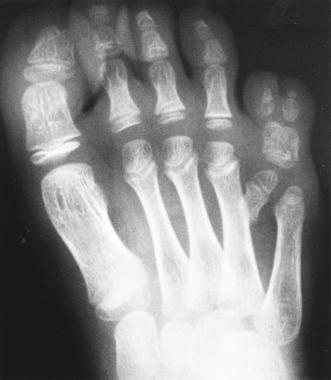 Varus petog prsta Varus petog prsta stopala izgleda kao poremećaj koji moguće bandažom i vježbama ispraviti. Međutim, radi se o vrlo tvrdokornom deformitetu koji ne reagira na konzervativne postupke.