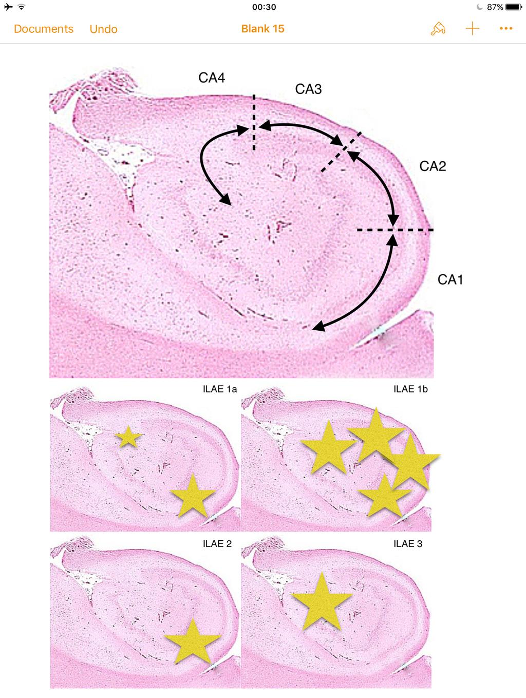 Slika 2: Shematski prikazani sektori Ammonovog roga na histološkoj slici hipokampusa, uz shematski prikaz tipičnih mjesta sklerotičnih lezija