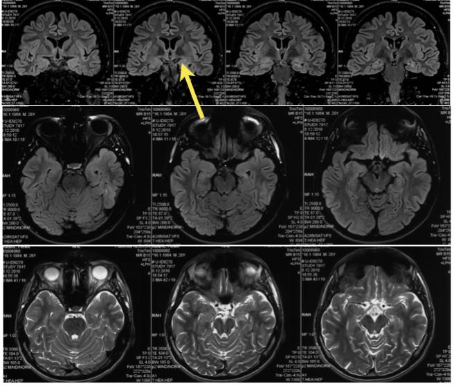 Slika 3: Hipokampalna skleroza lijevo.