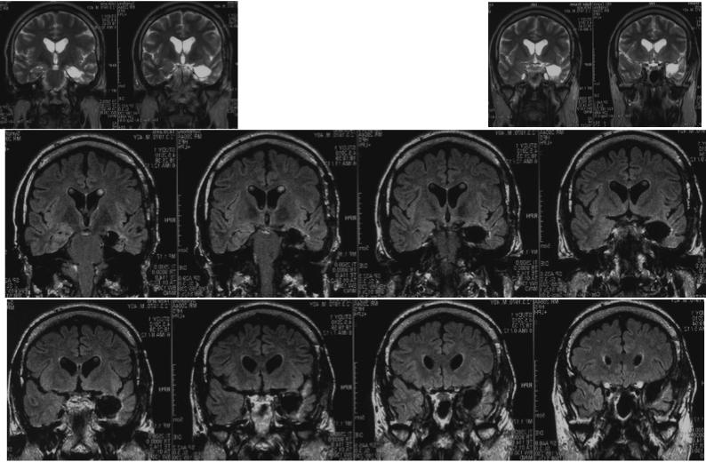 Slika 4: Postoperativni kontrolni MR u istog bolesnika kao i na slici 2.