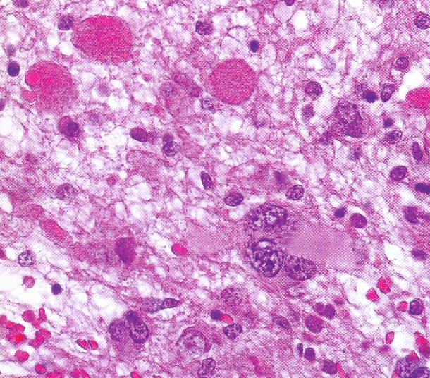 Slika 1. Gangliogliom (GII). Tumorsko tkivo je hipocelularno i građeno od polimorfnih iregularnih neuralnih stanica, ponekad i multinuklearnih. Zamjećuju se i granularna tjelešca. (HE, 400x) 2.