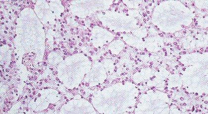 Slika 4. Difuzni astrocitom (GII). Tumorsko tkivo građeno je od fibrilarnih astroglijalnih unimorfnih tumorskih stanica koje zatvaraju pseudocistične prostore. (HE, 400x) 3.4. Oligodendrogliom Oligodendrogliom (slika 5) prvi put opisuju Bailey i Cushing 1926.