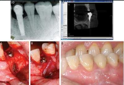 PREGLED LITERATURE / LITERATURE REVIEW THE TREATMENT OF NEW PERI-IMPLANT MUCOSITIS Motivation and counseling for the maintenance of oral hygiene While maintaining oral hygiene use appropriate brush