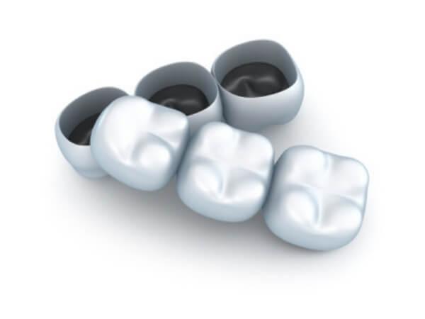 Postupak izrade metal-keramičkih kruna podrazumijeva brušenje zuba i uzimanje otiska nakon čega zubni tehničar u laboratoriju izrađuje metalnu konstrukciju.