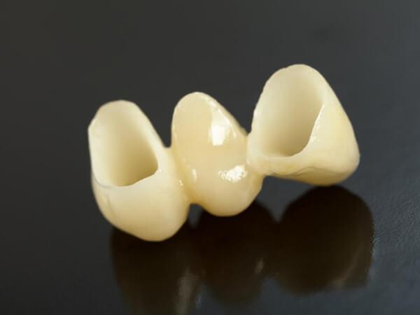 Samo uklanjanje zubne supstance da bi se postavila krunica je daleko manje, nego kod standardnih metal-keramičkih krunica.