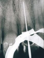 Slika 4. Prikaz prvoga sluëaja: Radiografska kontrola poloæaja glavnoga korijenskog instrumenta Figure 4.