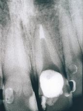 KliniËki je zub bio osjetljiv na perkusiju, bez otekline. Kanal je ispran i osuπen, ponovno napunjen Calaseptom i privremeno zatvoren sterilnom vaticom i Cavitom W.
