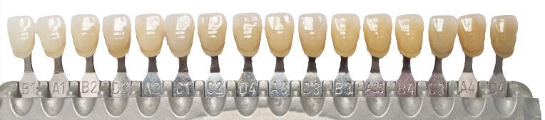 5.2. Boja zuba tjedan dana nakon izbjeljivanja Pacijentica je udlage napunjene gelom nosila tijekom noći tjedan dana.