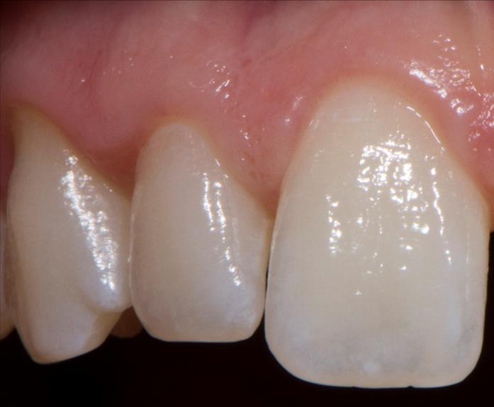 5.3. Boja zuba dva tjedna nakon izbjeljivanja Tijekom drugog tjedna cjelonoćnog nošenja udlaga pacijentica je koristila gel s većom koncentracijom karbamidova peroksida nego u prvom tjednu.