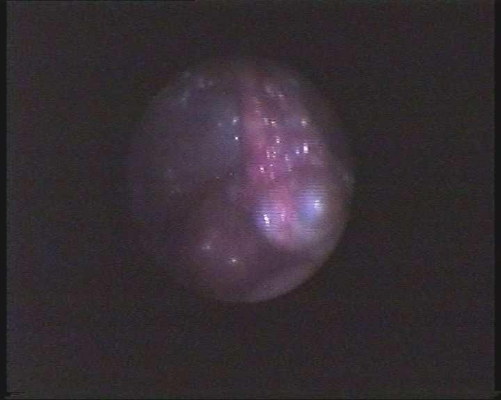 obojenom metilenskim modrilom u koju je dodan i antibiotik. Slika 1. Opsežne priraslice uterusa s okolnim organima Picture 1.