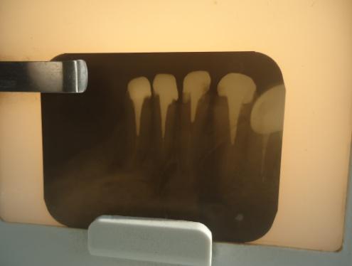 Retroalveolar picture of the endodontically treated teeth Slika