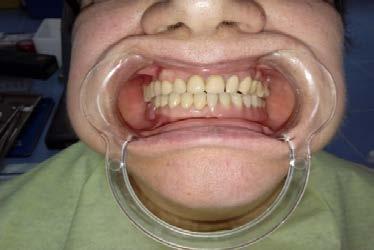 Intraoral dental bridge with Lecodent bars Slika 10.