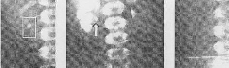 Acta Medica Medianae 2006, Vol. 45 Slika 3. Uspešna dezintegracija i eliminacija kamena lokalizovanog u desnom ureteropijeličnom segmentu bolesnika B. M. uzrasta 7, bez auksilijarnih procedura Slika 4.