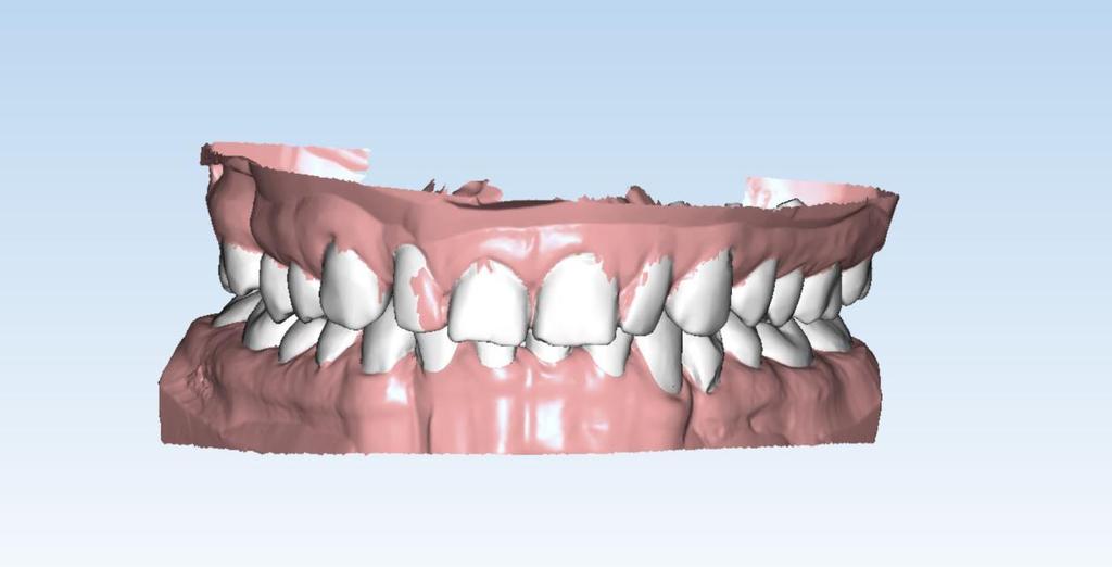 Digitalni virtualni model prije virtualnog pomicanja zuba