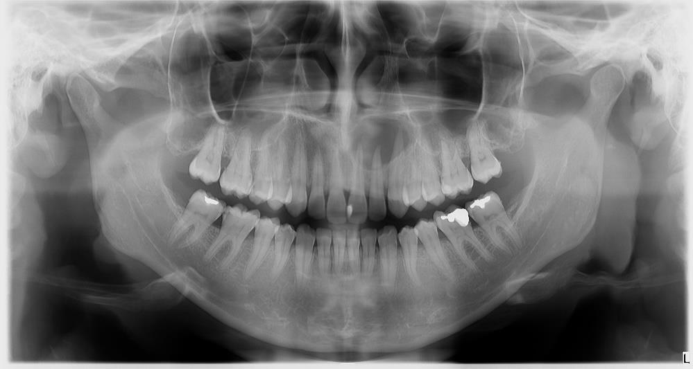 Slika 3. Radiološki nalazi dobiveni snimanjem ortopantomograma. Preuzeto s dopuštenjem autora: Prof. dr. sc.