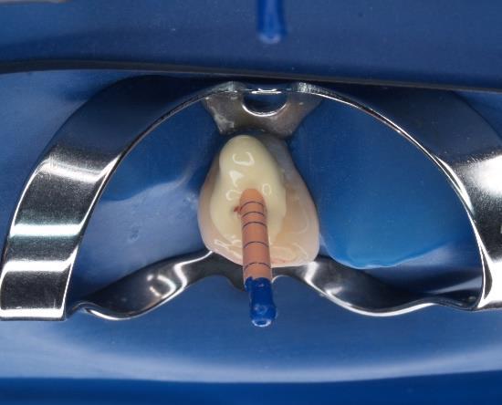 Velike periapikalne lezije, koje imaju izravnu komunikaciju s korijenskim kanalima, dobro reagiraju na endodontsko liječenje uz primjenu TAP-e.