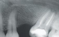 »estoÊa toëno ispunjenih korijenskih kanala prema vrsti endodontskoga zahvata i broju korijena zuba (jedno-, dvo- i trokorijenski zubi) Figure 5.