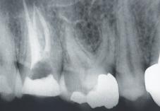 Rtg slika nakon endodontskoga tretmana Figure 3. Radiographic control after endodontic treatment Slika 4. Rtg slika nakon endodontskoga tretmana Figure 4.