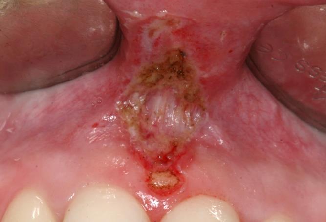 Slika 7. (desno) Početno stanje frenuluma prije operacije (lateralno). Preuzeto s dopuštenjem autora: doc.dr.sc.