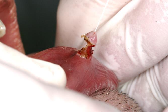 dr.sc. Domagoj Vražić. Slika 19. (desno) Lasersko uklanjanje fibroma.