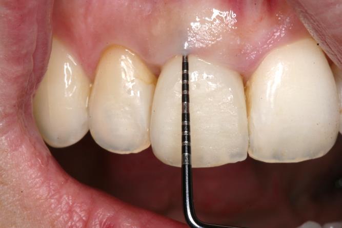 Sljedeći slučaj prikazan na Slikama 24 29 pokazuje u nekoliko postupaka mekotkivno produljenje krune zuba.