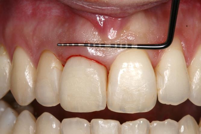Slika 26. (lijevo) Projekcija dubine sulkusa na zubnom mesu. Preuzeto s dopuštenjem autora: doc.dr.sc. Domagoj Vražić.