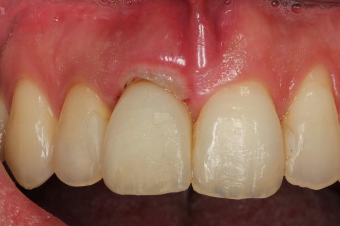 Domagoj Vražić. 4. Liječenje perikoronitisa Perikoronitis je infekcija oralne mukoze oko djelomično izniklog zuba.