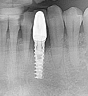 liječenje periimplantitisa ukoliko neadekvatna higijena dovede do parodontne bolesti oko implantata.