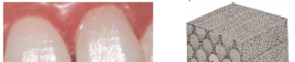 1.3.1 Caklina Caklina je najtvrđi dio zuba i čini jedan od četiri najbitnijih dijelova zuba.
