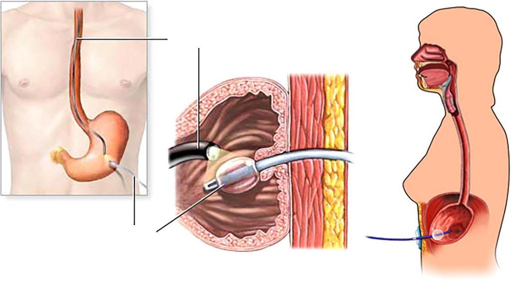 PEG podrazumijeva postavljanje posebnog katetera kroz mali rez u trbušnoj stjenci, koji služi za prehranu pacijenta (enteralna prehrana).