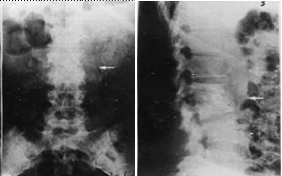 Slika 1. Rendgenske (RTG) snimke torakolumbalne kralješnice u bolesnika s Pottovom bolesti.