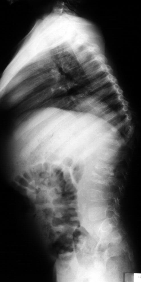 Slika 3. Latero-lateralna rendgenska snimka kralješnice bolesnika sa slike 2. Vidljiva je kifoza u području 10-12.