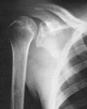 Slika 5. Anteriorno-posteriorna rendgenska snimka akutne tuberkuloze desnog ramenog zgloba s znakovima osteoporoze kostiju ramena.