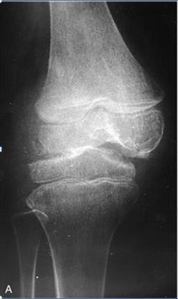 Slika 8. Anteriorno-posteriorna rendgenska snimka koljenskog zgloba kod bolesnika s tuberkulozom zgloba koljena.