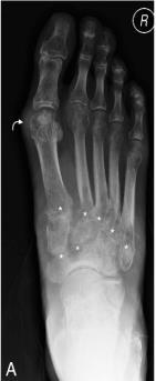 Slika 10. Anteriorno-posteriorna rendgenska snimka desnog stopala kod bolesnika s tuberkulozom stopala.