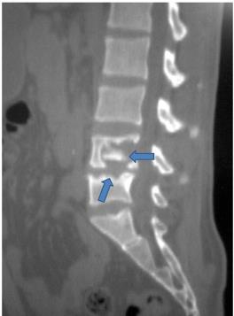 Slika 12. Sagitalna snimka lumbalnog dijela kralješnice učinjena kompjuteriziranom tomografijom kod bolesnika s koštanom tuberkulozom. Strelice pokazuju destrukciju tijela lumbalnih kralješaka.