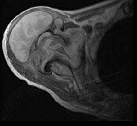 Slika 13. Sagitalna snimka magnetske rezonancije kralješnice bolesnika s Pottovom bolesti u T1 prikazu.
