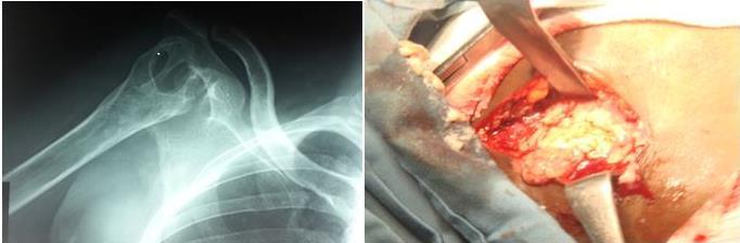 postigla željeni rezultat, indicirana je artrodeza zgloba kojom se rješava bol te korigira deformacija (14). Slika 17. Slika lijevo prikazuje rendgensku snimku tuberkuloznog artritisa desnog ramena.