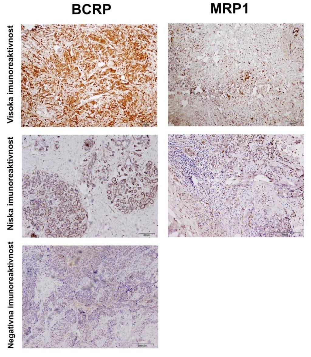 4.4 Analiza ekspresije BCRP i MRP1 proteina u karcinomima dojke i zdravom tkivu dojke U ovom doktorskom radu ispitana je i analizirana ekspresija dva membranska transportera BCRP i MRP1, u maligno