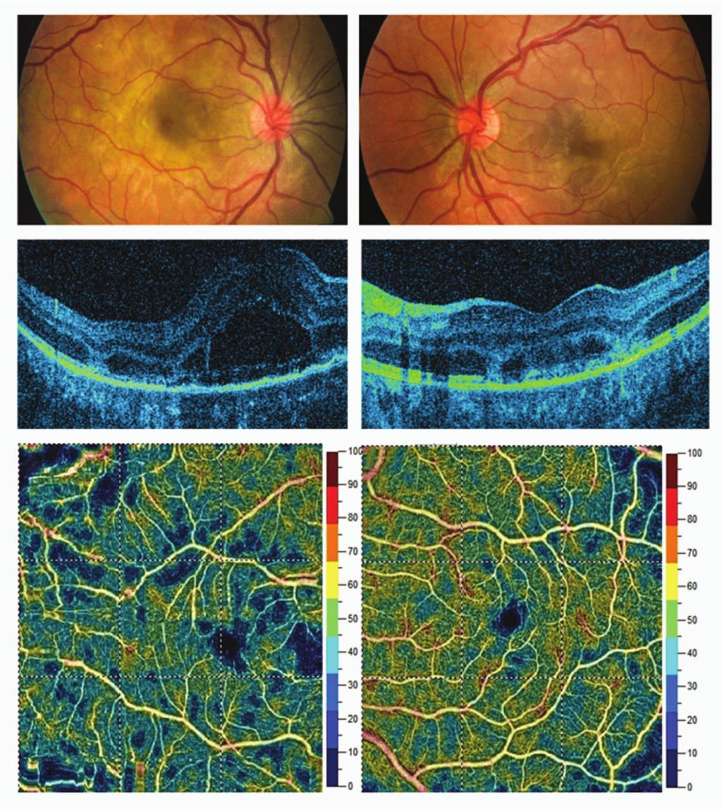 a b c d e f Slika 1. Slike fundusa, OCT (engl. optical coherence tomography) i OCT angiografija (OCT A) u početnoj fazi bolesti.