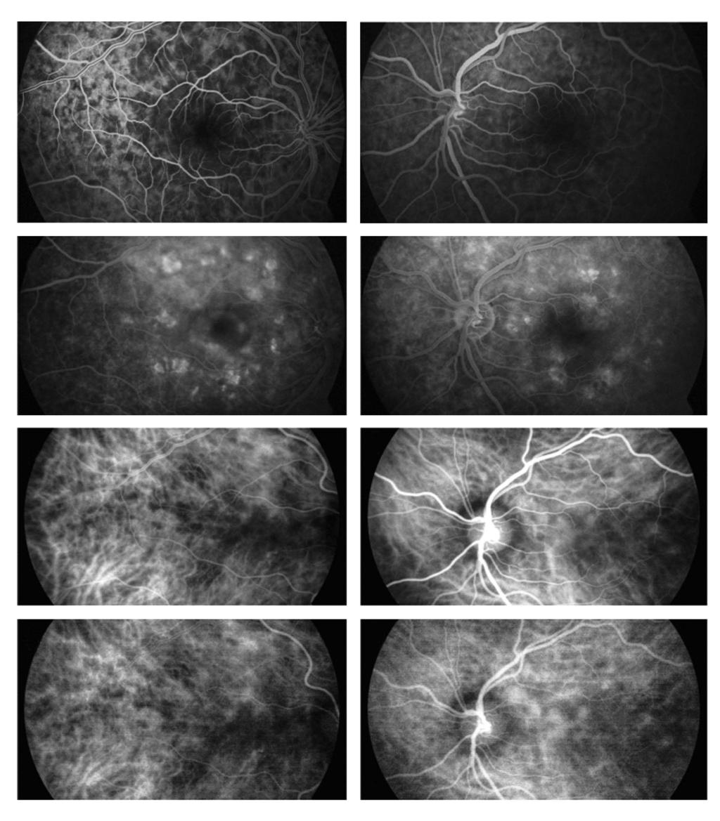 a b c d e f g h Slika 2. Slike angiografije na početku bolesti. Hipofluorescencija u ranoj fazi (a,b), hiperfluorescencija u kasnoj fazi FA (fluoresceinska angiografija) (c,d).