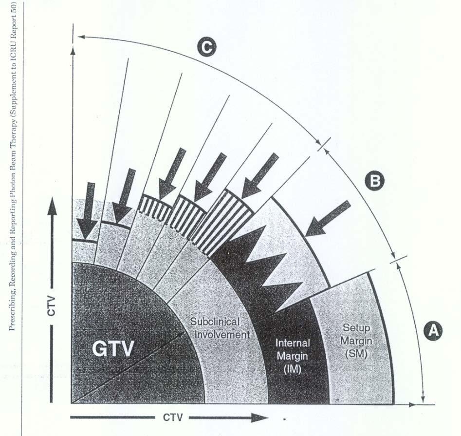 ICRU - 62 (1999.): CTV < PTV MARGINA = IM (internal margine) - pokriva amplitudu pokreta ciljnog volumena unutar pacijenta + SM (set-up margine) pokriva set-up geometrijskugrešku.