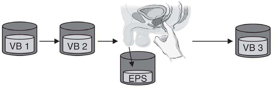 Slika 1. Pokus četiri čaše. Metoda sekvencijalnog uzimanja uzorka mokraće i eksprimata prostate [prilagođeno prema (71)] Masaža prostate VB 1 (od engl.