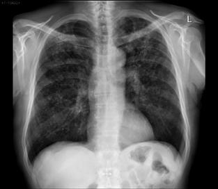 Anteroposteriorna (AP) rendgenska snimka prsnog koša Figure 4 Antero-posterior (AP) view of chest radiograph Slika 5.