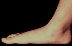 1. UVOD 1.1. Čukljevito stopalo (hallux valgus) opšti deo Značaj haluks valgus deformiteta (čukljevitog stopala) je u tome što je veoma čest, posebno kod žena.