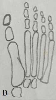 Prvi je egipatsko stopalo kod kojeg je palac duži od drugog prsta, drugi tip je kvadratno stopalo gde su palac i drugi prst iste dužine i treći tip stopala je grčko, gde je