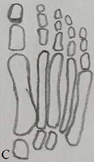 Šhematski prikaz tipova stopala: egipatsko stopalo( A), kvadratno stopalo(c), grčko stopalo(b) Najveća predispozicija za nastanak haluks valgusa postoji kod egipatskog tipa