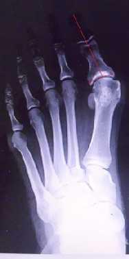 Ugao koje zaklapaju uzdužne osovine proksimalne i distalne falange palca je IFU ugao. Kod zdravog stopala vrednosti interfalangealnog ugla su od 0-5 o ( slika 24).