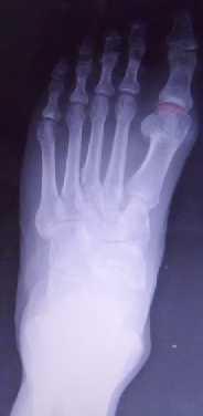 Radiografski prikaz kongruentnosi MTF zgloba palca levog stopala Prvi MTF zglob je kongruentan kod zdravog stopala, odnosno konkavitet zglobne površine baze